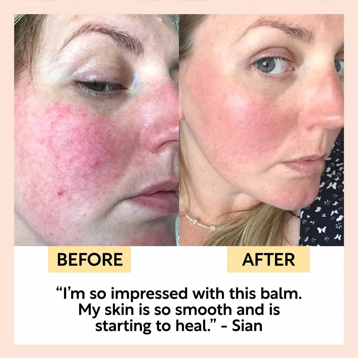 UpCircle Beauty Cleansing Face Balm with Vitamin E before and after of white lady with rosacea