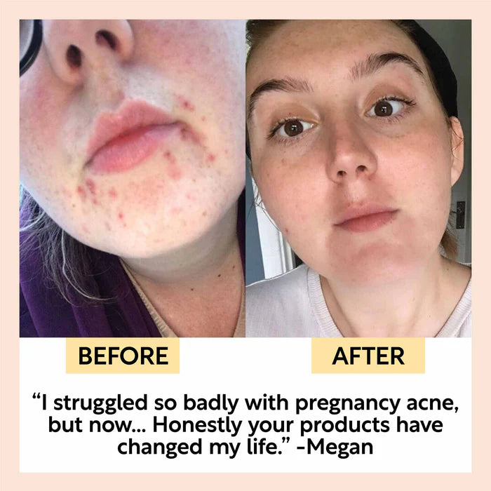 UpCircle Beauty Face Moisturiser with Vitamin E before and after acne