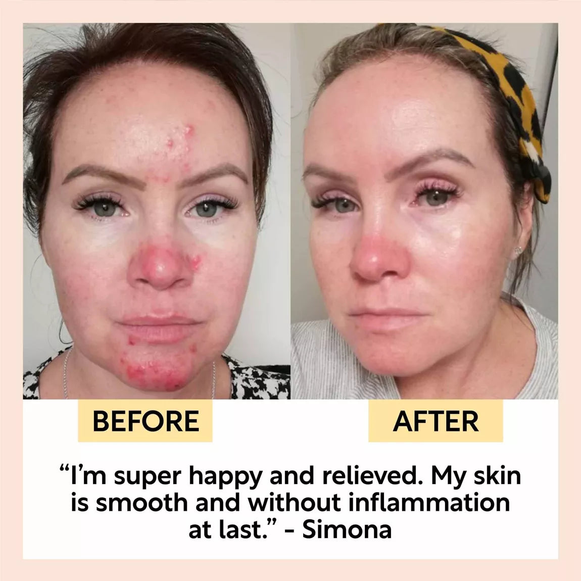 UpCircle Beauty Night Cream with Hyaluronic Acid + Niacinamide before and after acne