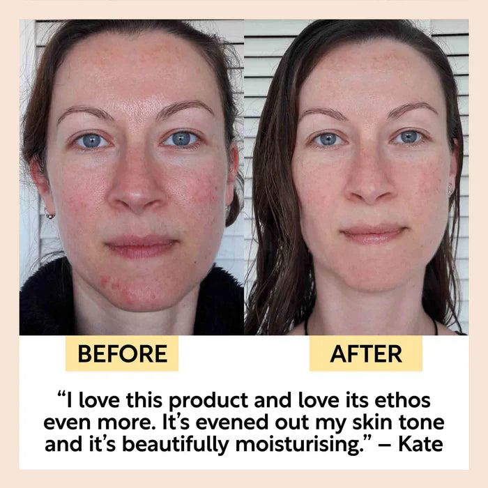 UpCircle Beauty Organic Face Oil with Coffee Extract before and after rosacea