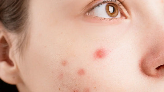 Woman with redness and acne on face