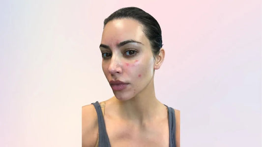 How Did Kim Kardashian Treat Psoriasis? The Complete Journey & What Works