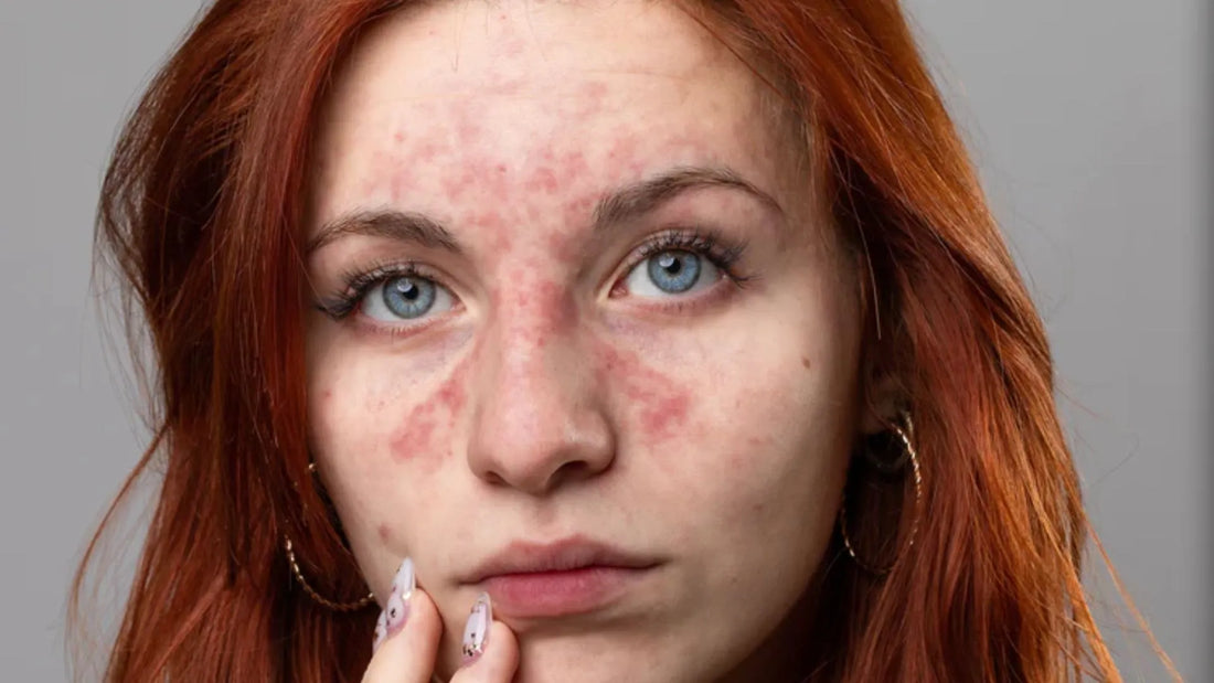 Ginger woman with Rosacea