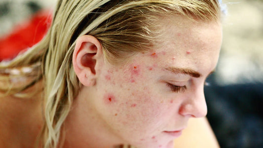 Blonde lady with acne spots