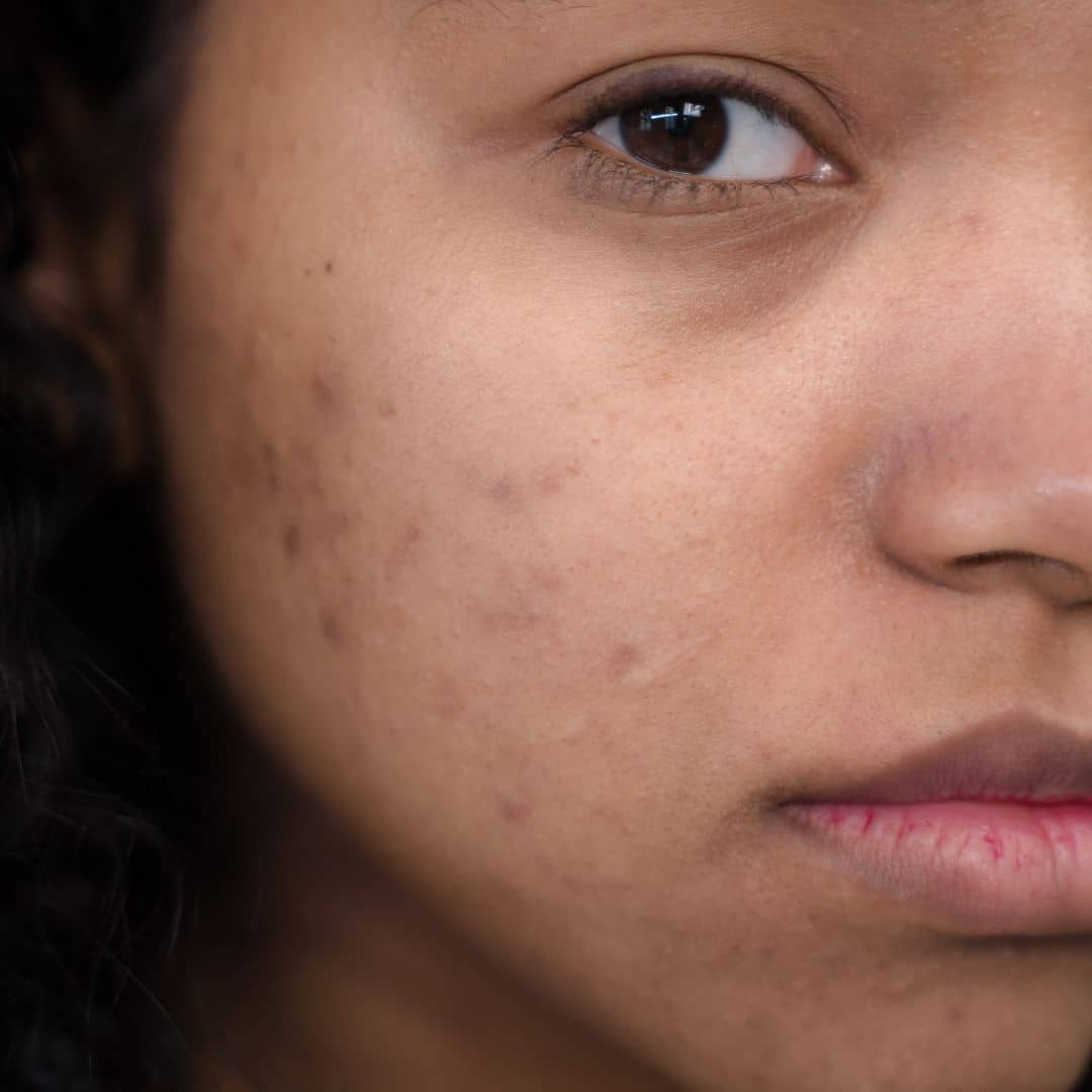 Woman with acne and blemishes