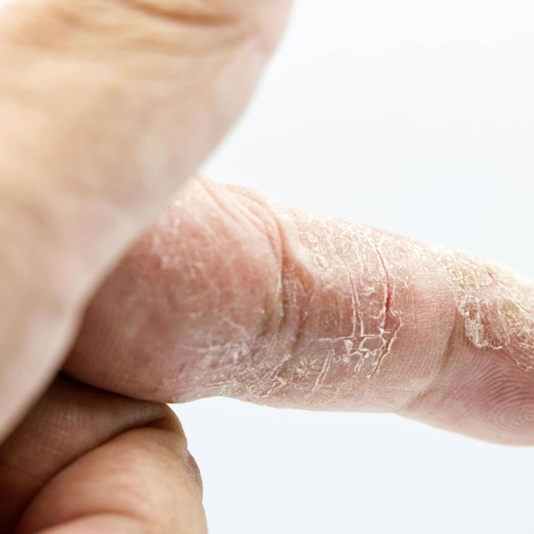 Woman with eczema on fingers
