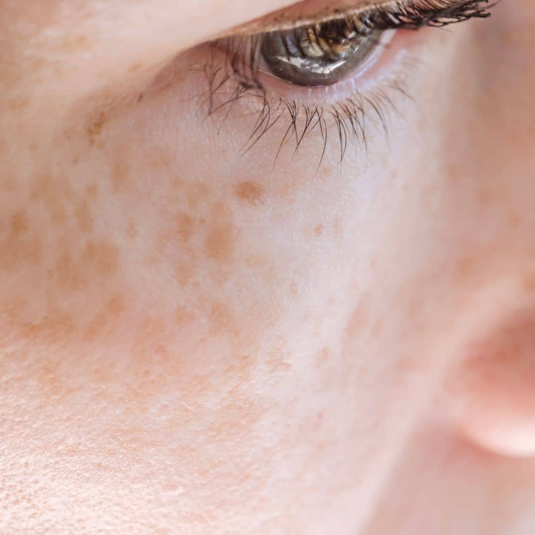 Woman with pigmentation