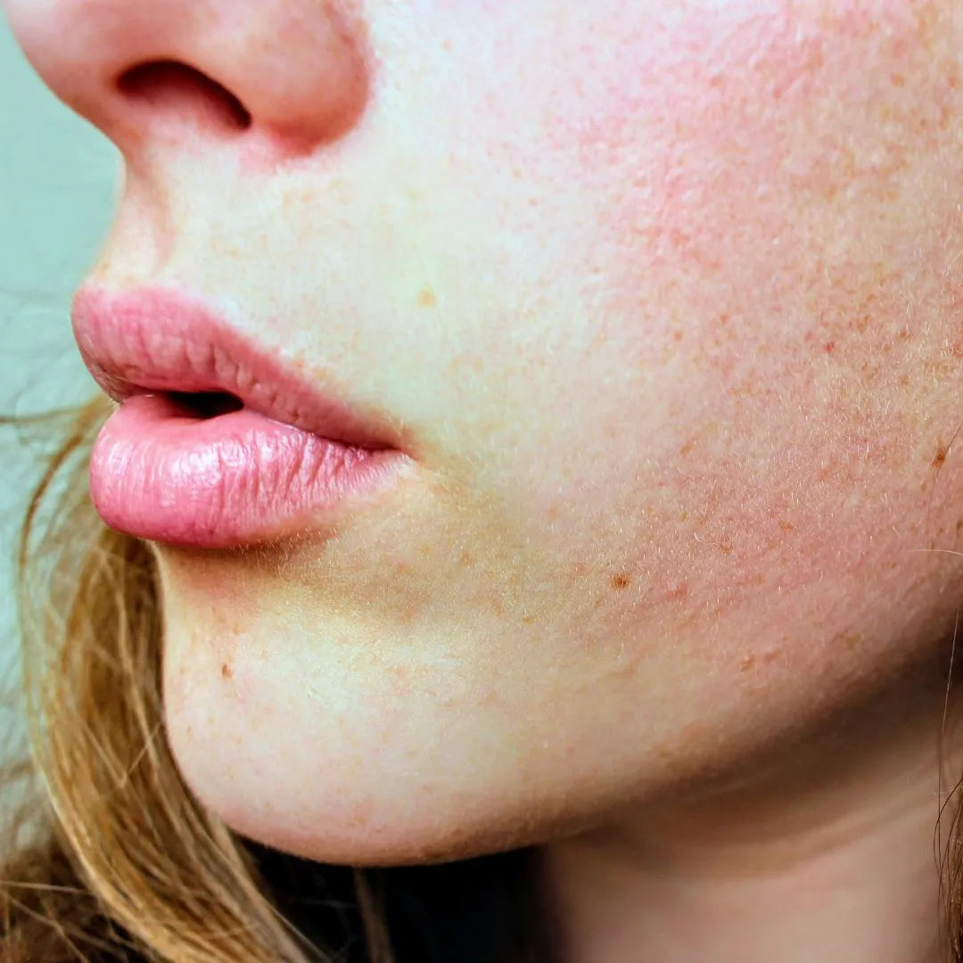 Blonde woman with rosacea
