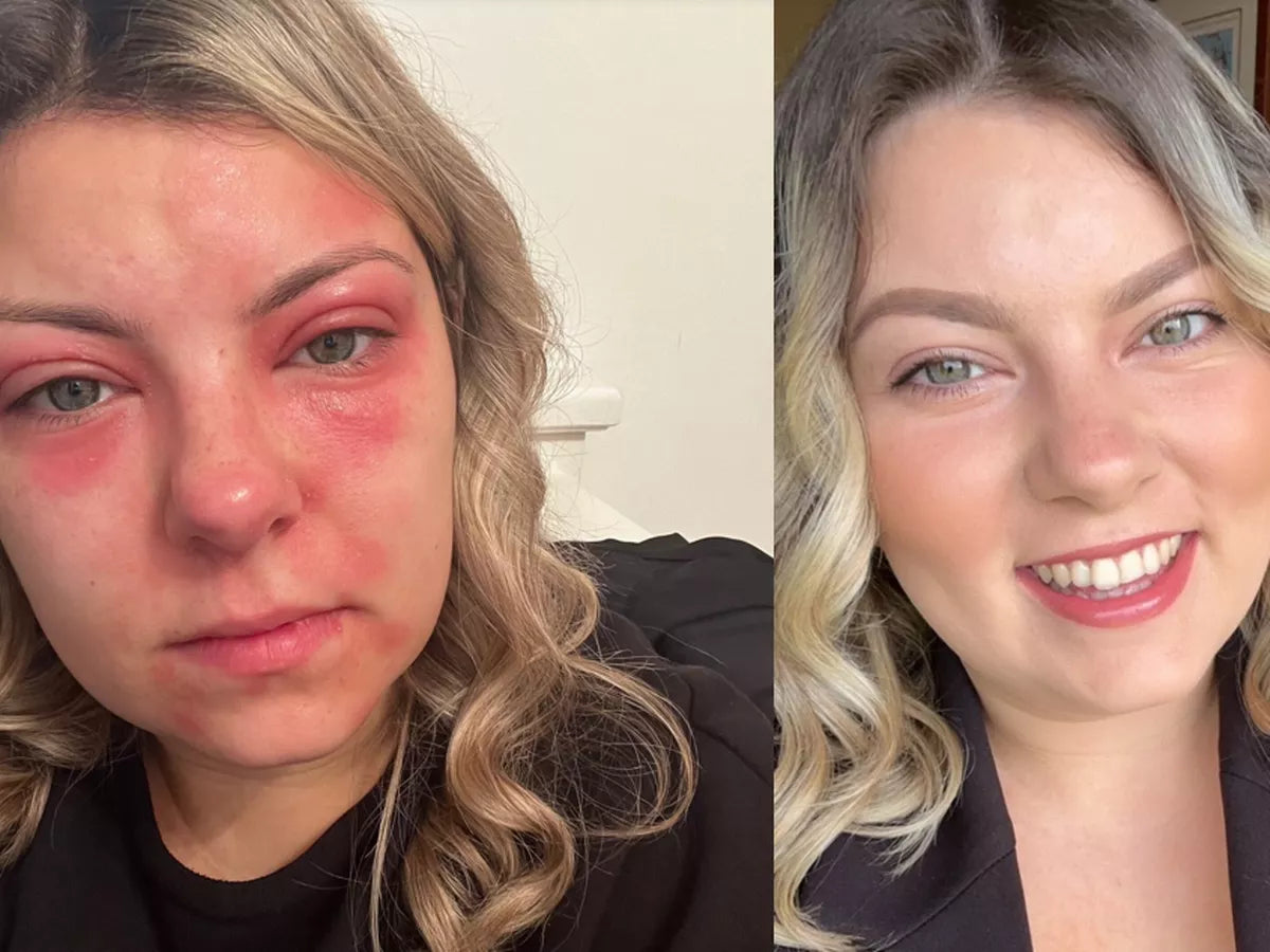 Before and after photos of lady with eczema with blonde hair