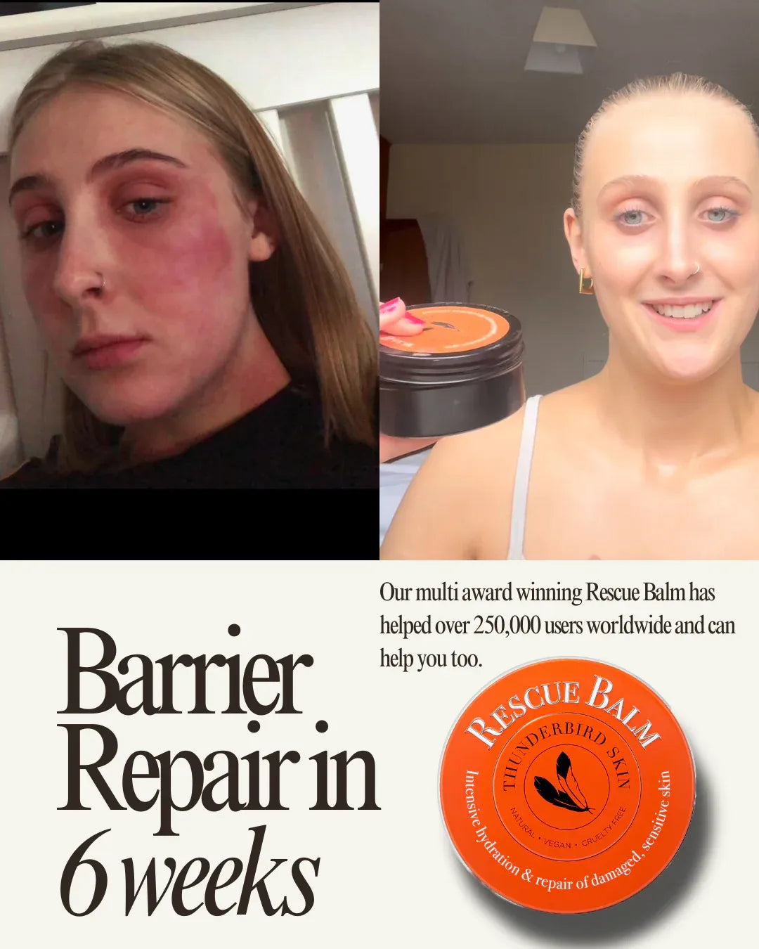 Before and after of a woman with face eczema holding Rescue Balm
