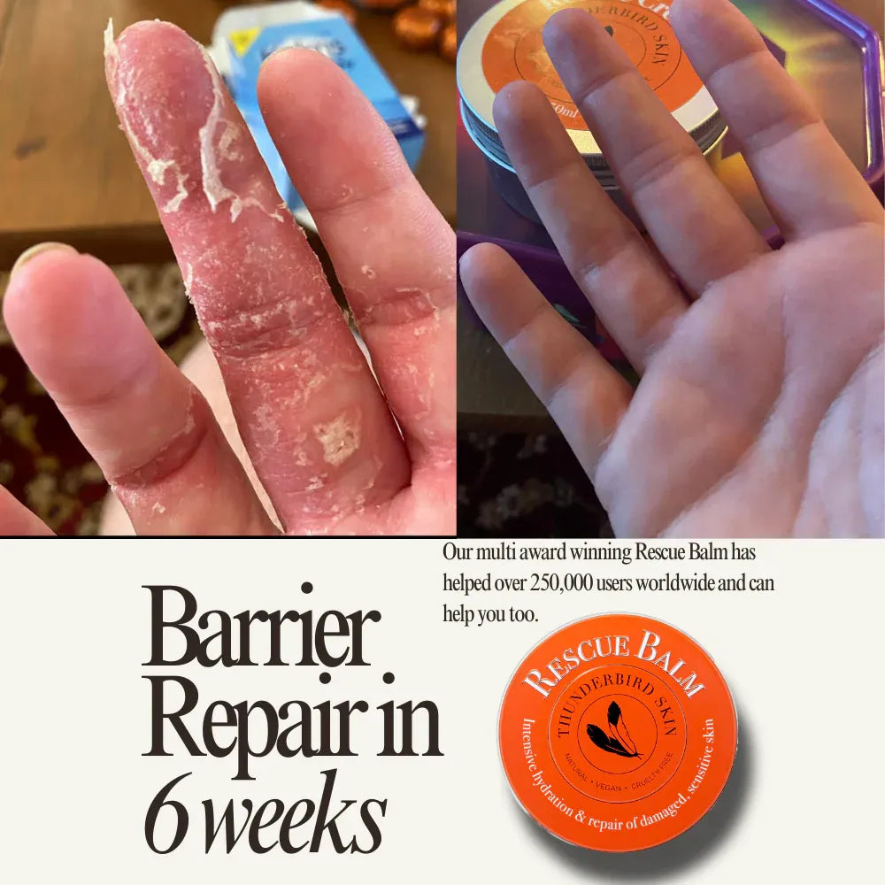 Before and after of a person with finger eczema with an image of Rescue Balm