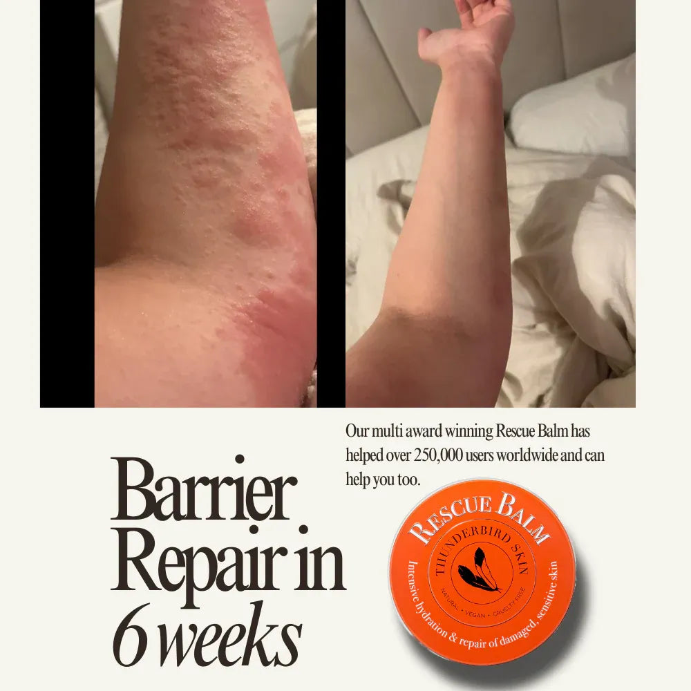 Before and after of a person with arm eczema with an image of Rescue Balm