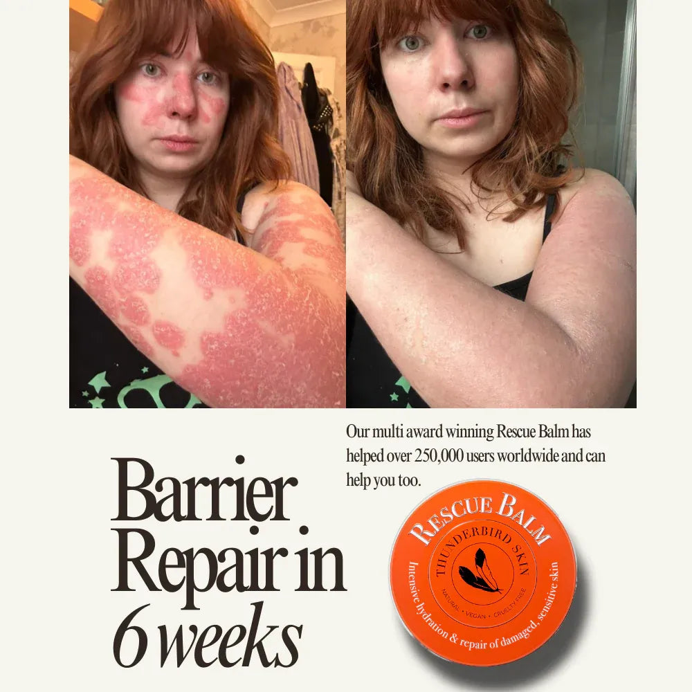 Before and after comparison of a person's skin with a product advertisement for 'Rescue Balm'.
