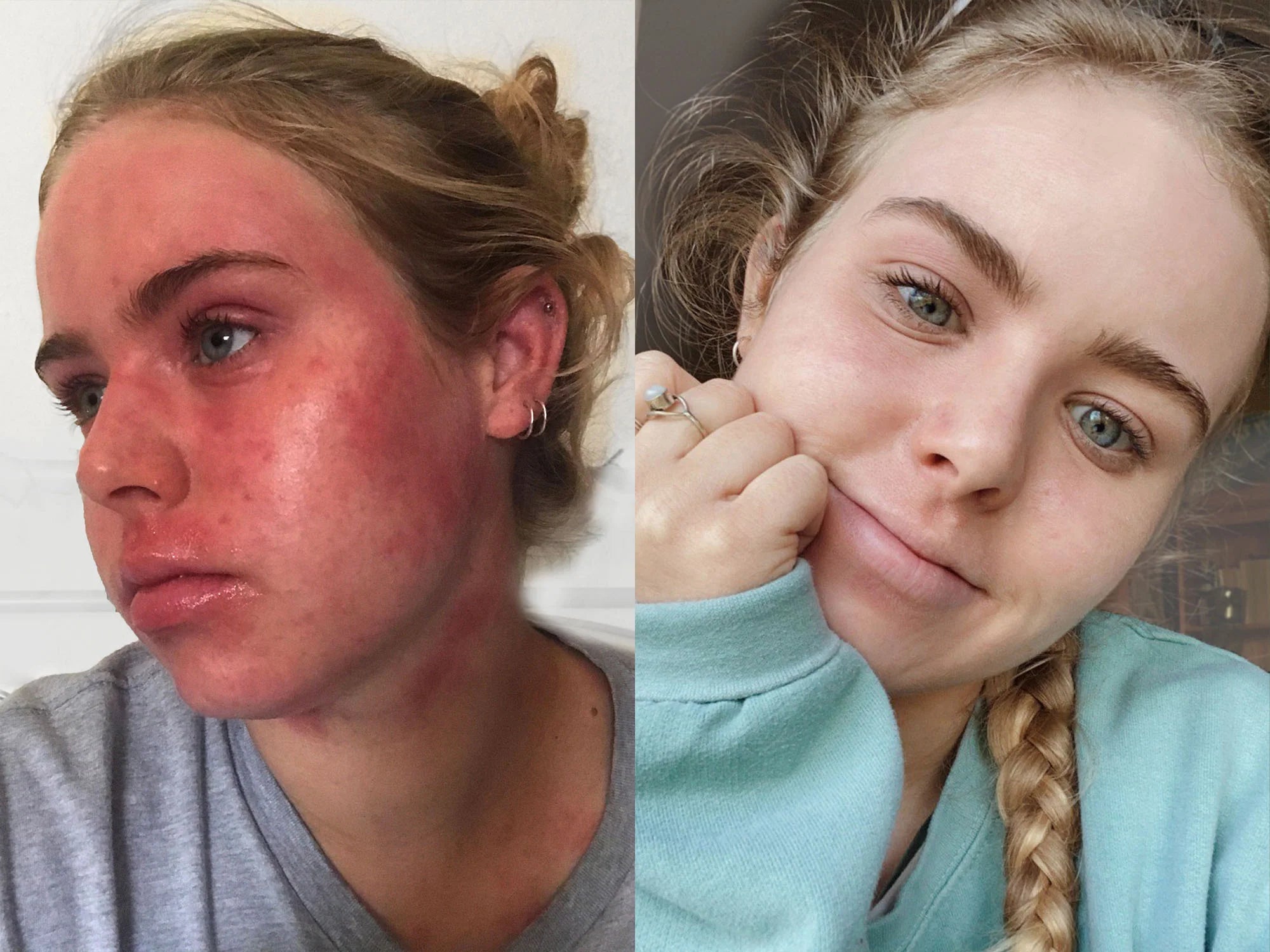 Before and after photos of lady with eczema with blue top