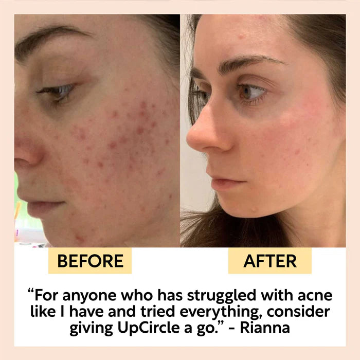 UpCircle Beauty Face Toner with Hyaluronic Acid before and after acne