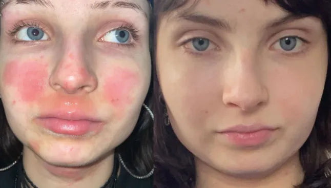 Before and after photos of lady with eczema with blue eyes